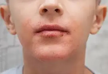 Perioral-Dermatitis