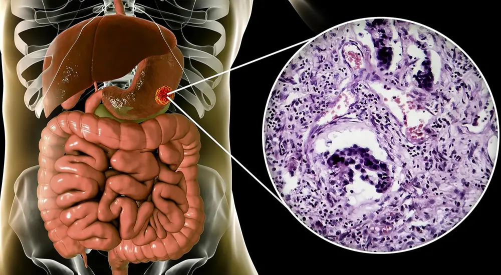 adenocarcinoma-diet-management