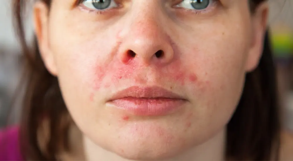 perioral-dermatitis-diet