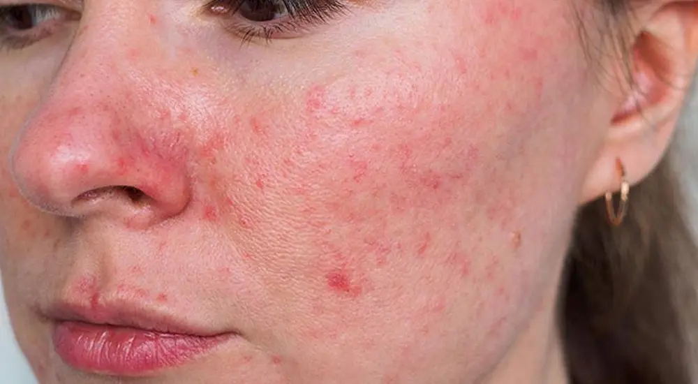 rosacea-diet