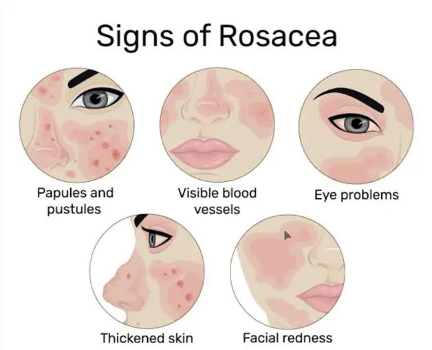 rosacea-signs
