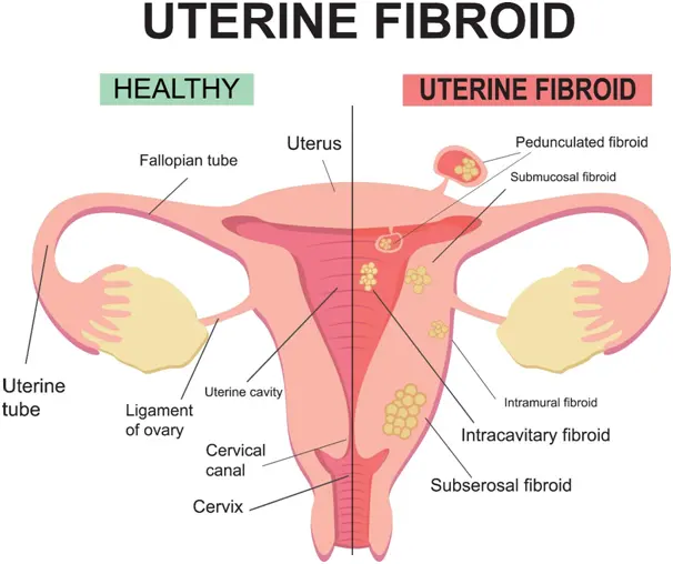 uterine-fibroid