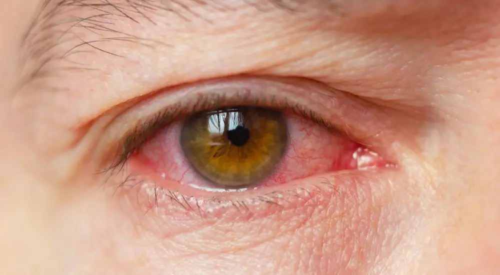 uveitis-diet